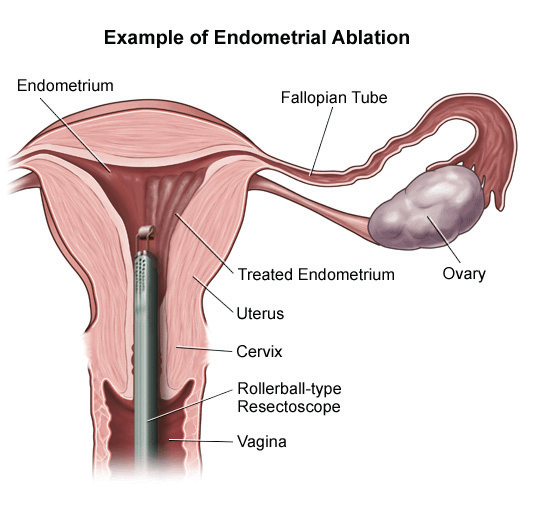 Endometrial Ablation FINAL Endometrial Ablation
